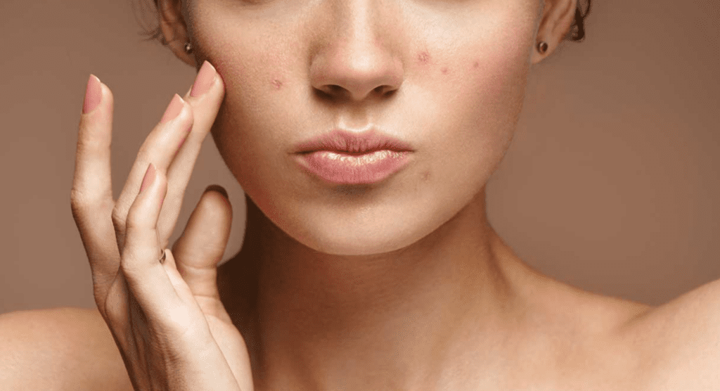 Como Combater a Acne e Conquistar uma Pele Saudável