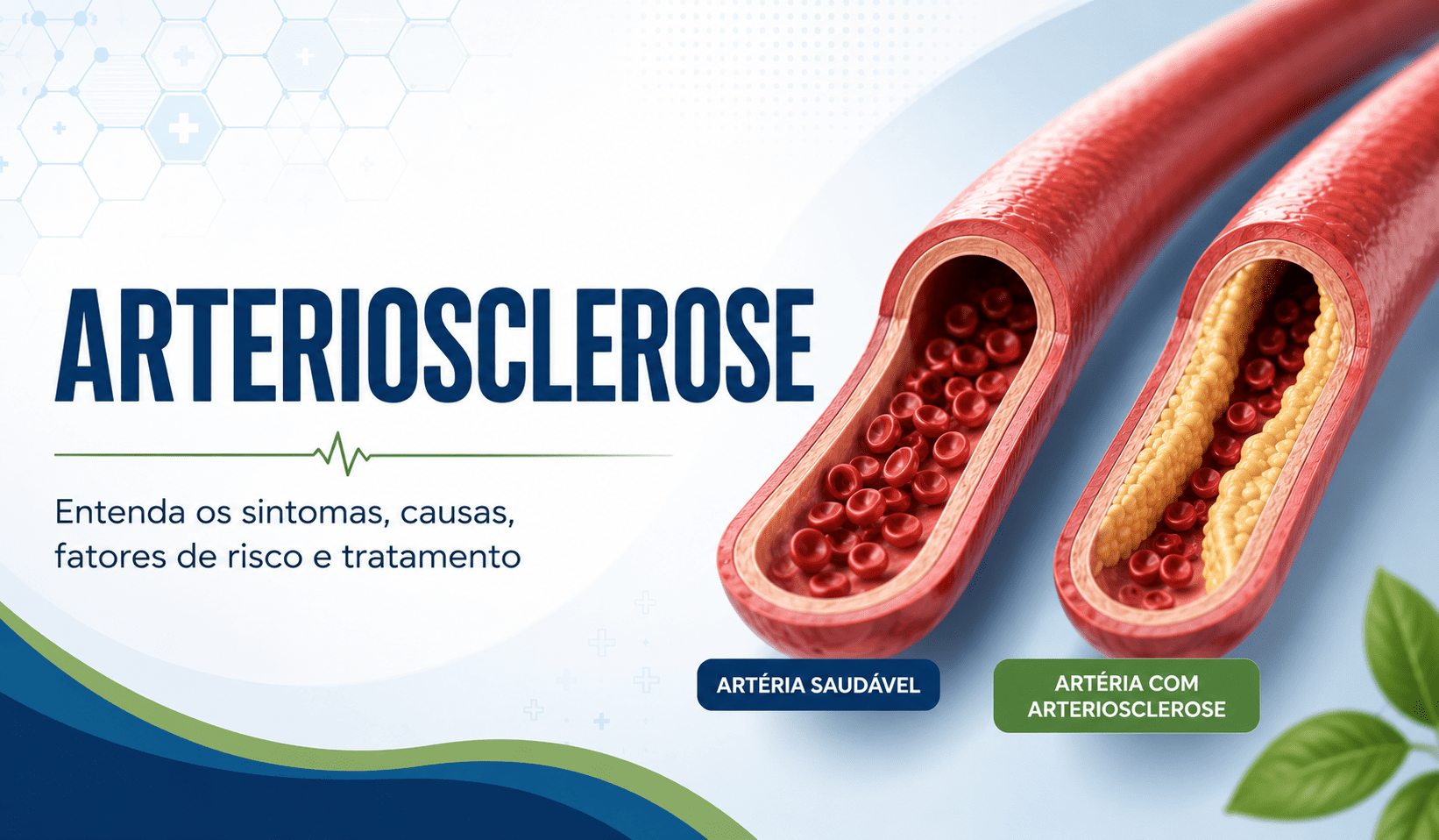 Artéria afetada pela arteriosclerose com acúmulo de placas e redução da circulação sanguínea