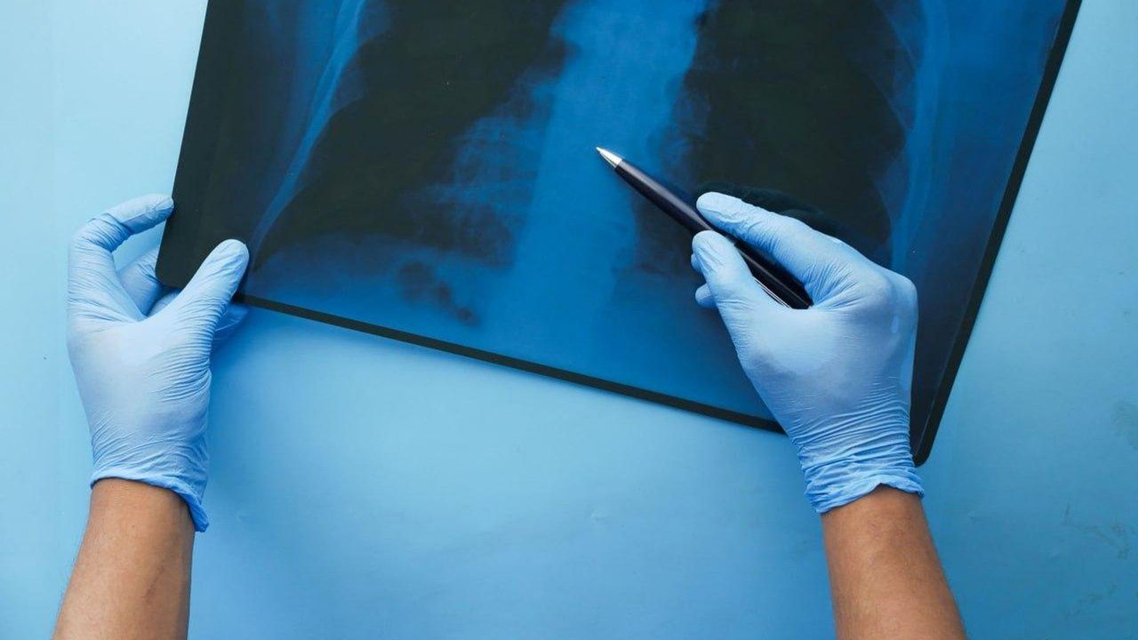 Microplásticos encontrados nos pulmões de pacientes com câncer