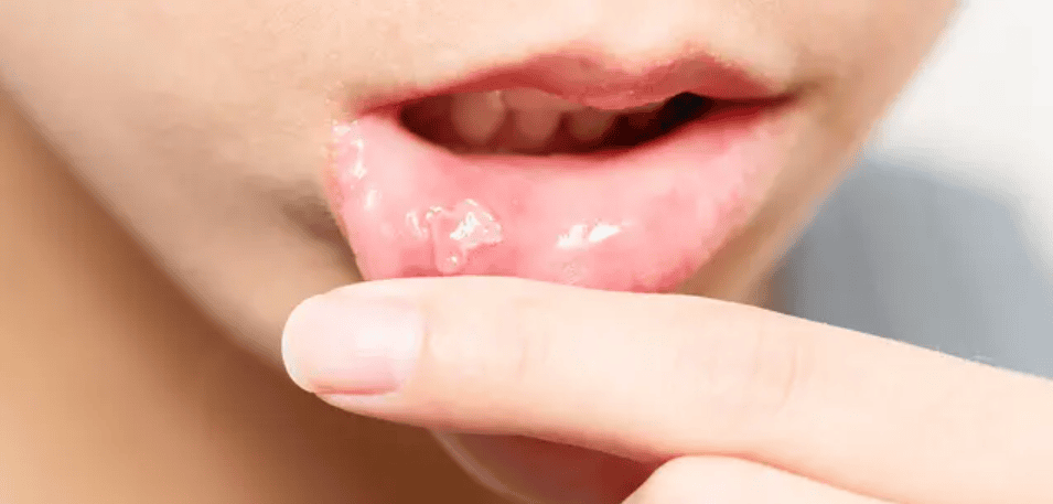 Imagem de afta na boca mostrando lesão ulcerada na mucosa oral