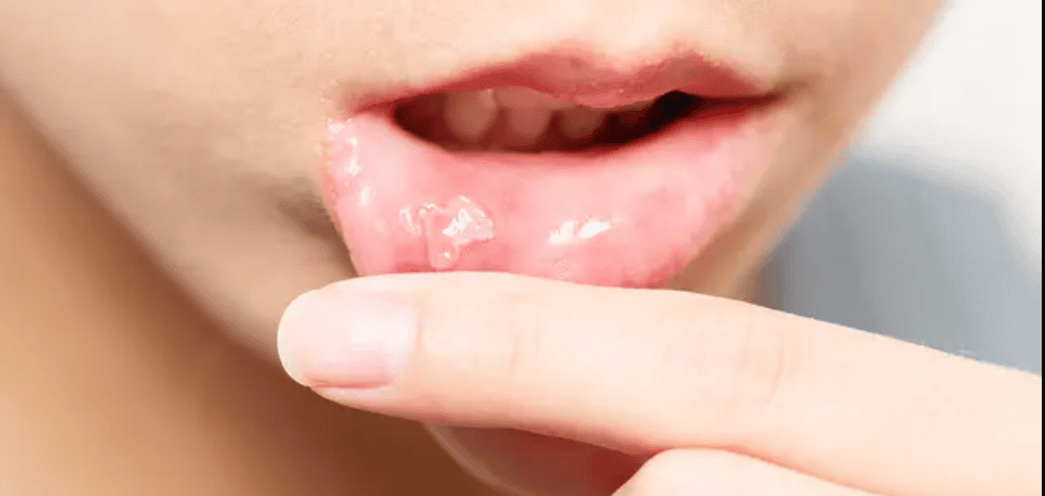 Imagem de afta na boca mostrando lesão ulcerada na mucosa oral